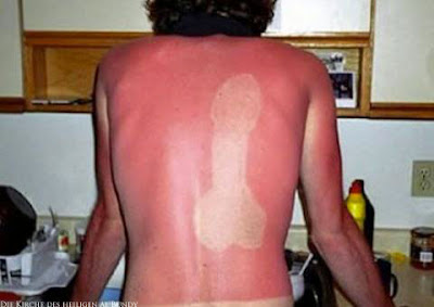 Lustige Sonnenbrand Bilder - Sommersonne witzig Lustige Sonnenbrand Bilder - Sommersonne witzig